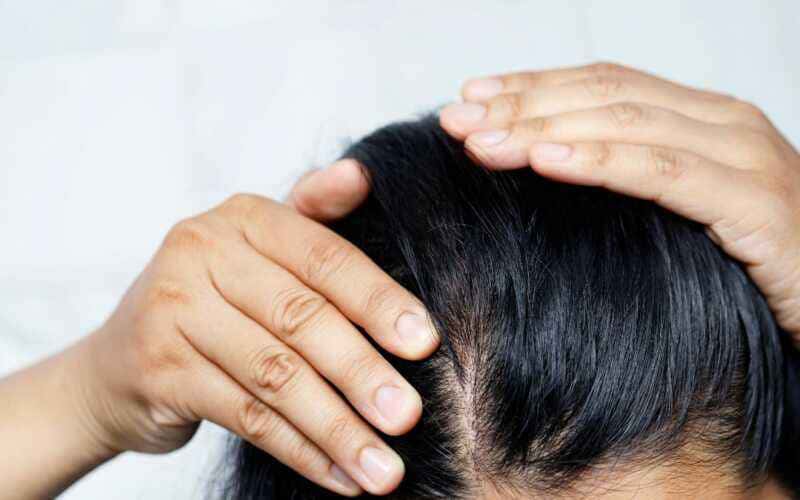 mesoterapia capilar