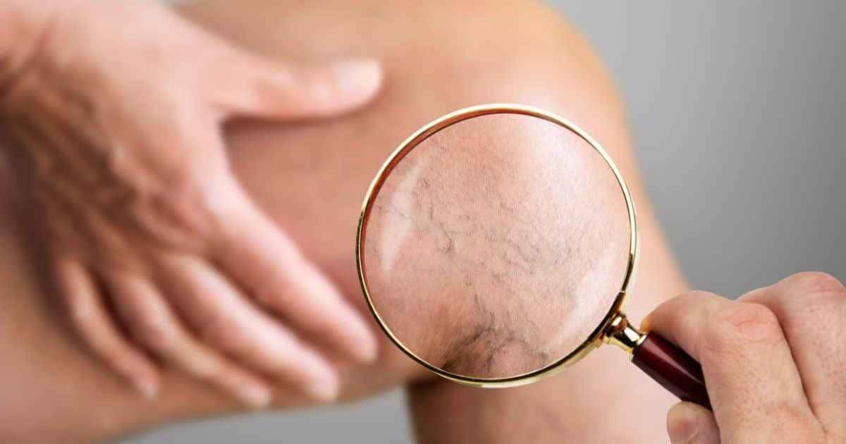 Como evitar as varizes e porque elas aparecem? Saiba o que fazer e como prevenir.