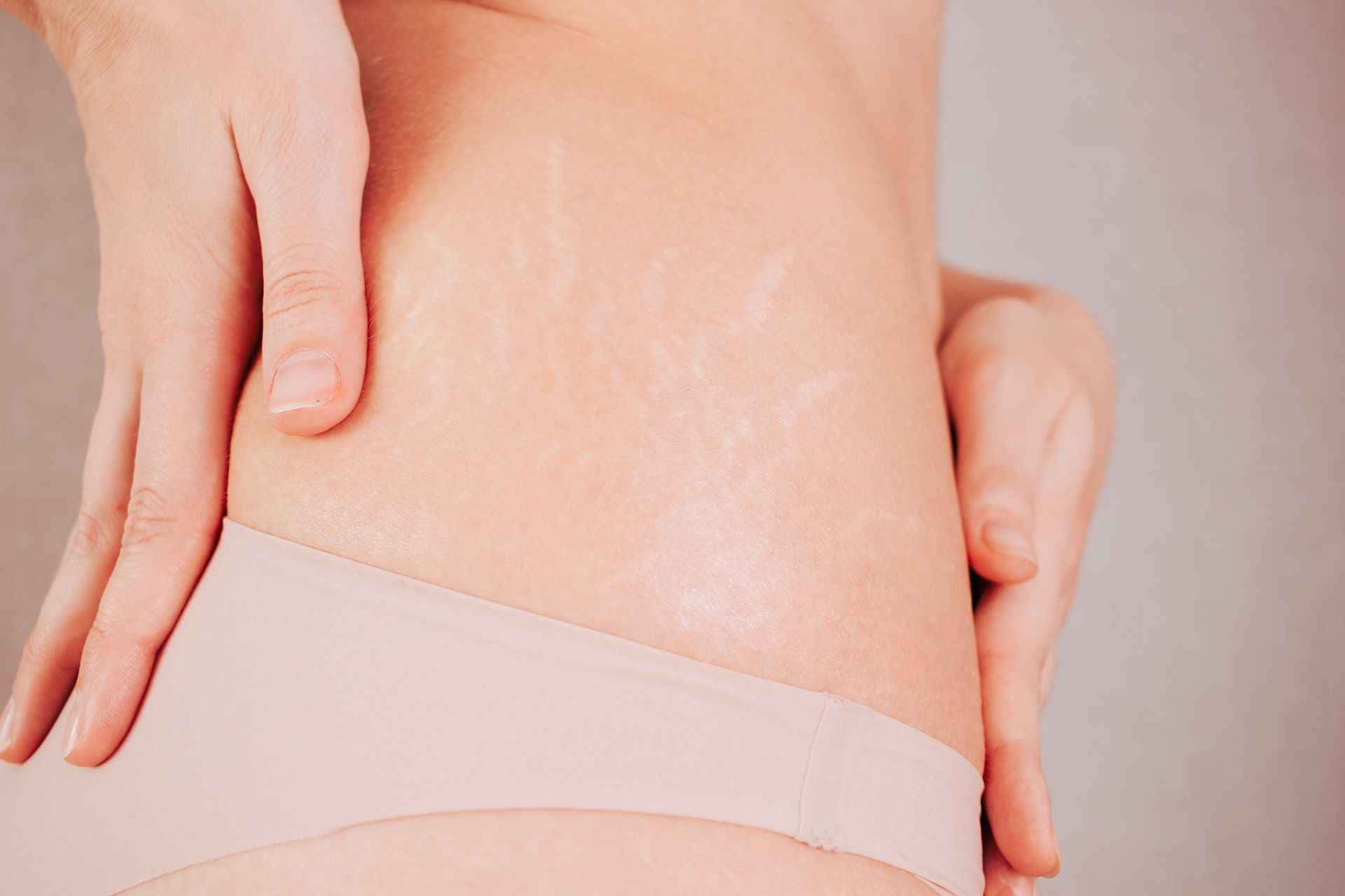As estrias são marcas que acompanham muitas mulheres ao longo da vida, resultado de mudanças abruptas no corpo, como o crescimento na adolescência, a gestação e variações significativas de peso. Embora sejam perfeitamente normais, essas marquinhas podem gerar preocupações. Vamos desvendar como as estrias surgem e, mais importante, como evitá-las de forma natural.