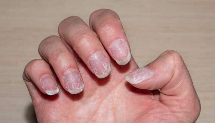 Por que suas unhas descamam? Descubra as causas e soluções