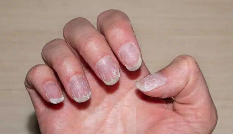 Por que suas unhas descamam? Descubra as causas e soluções