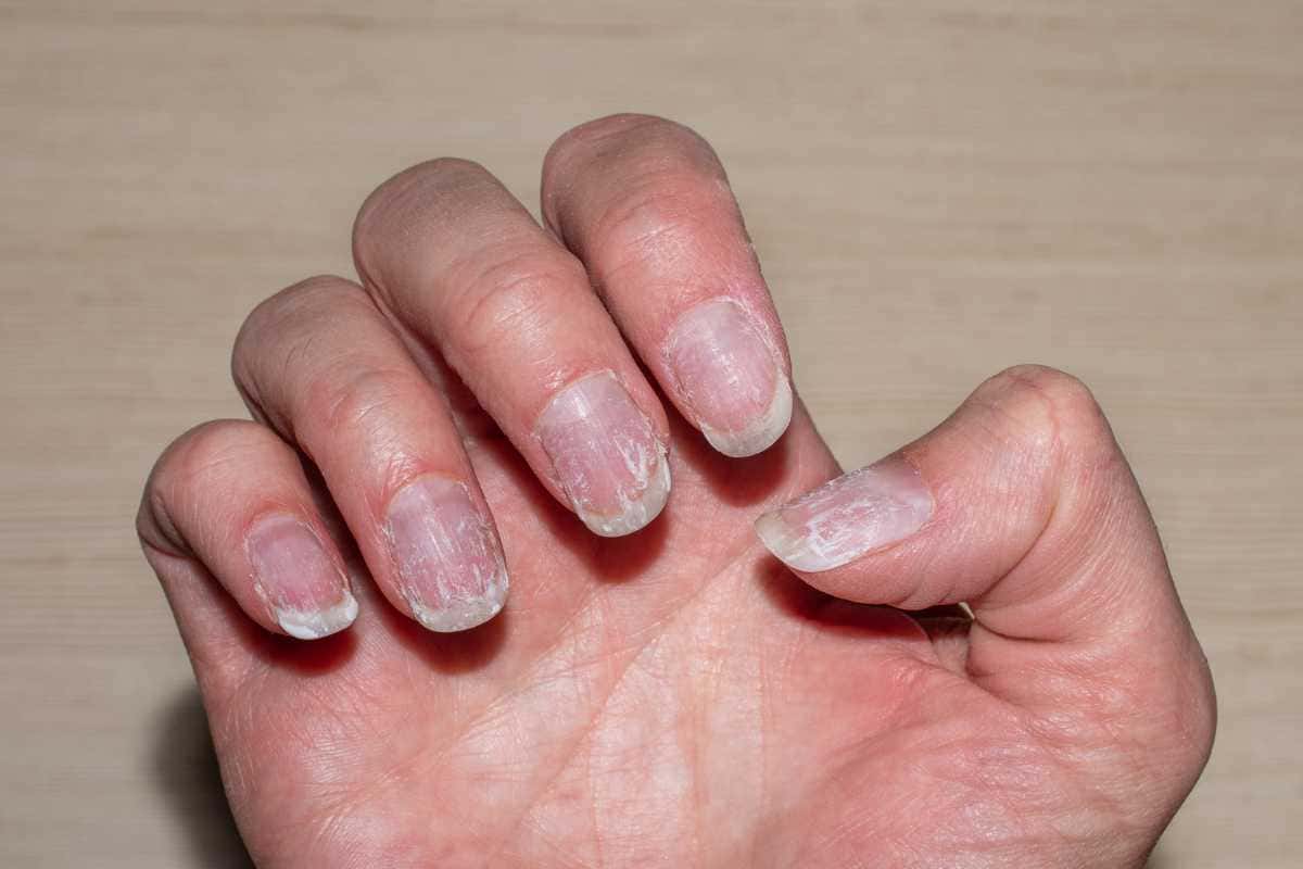 Por que suas unhas descamam? Descubra as causas e soluções