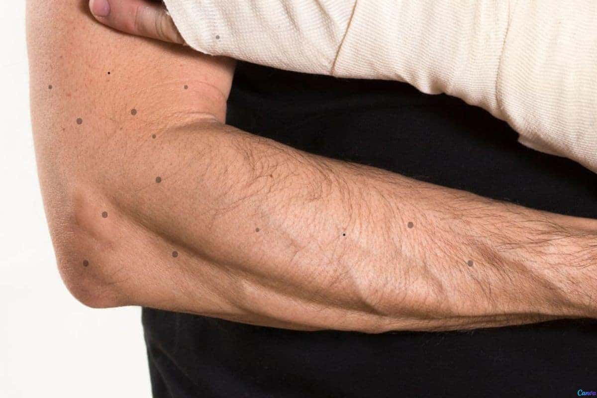 Como eliminar a queratose pilar (bolinhas nos braços) de forma natural