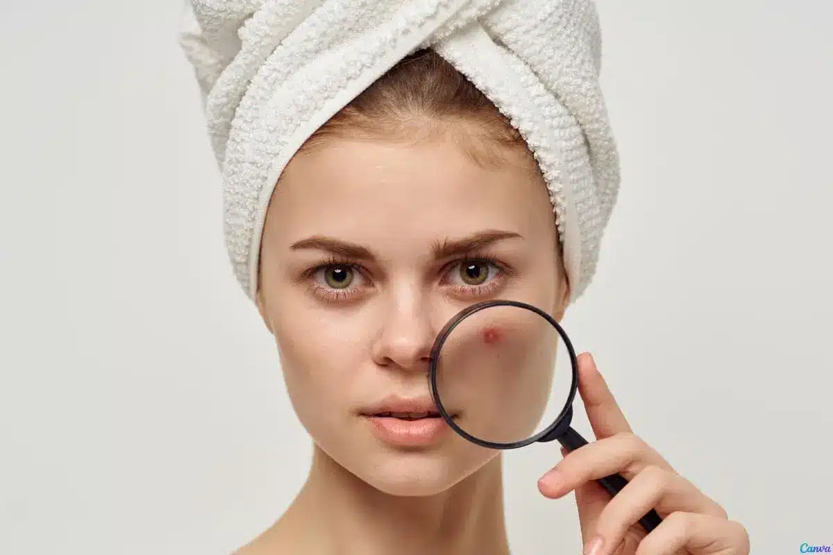 Skincare para quem tem acne